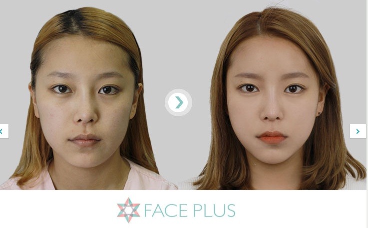 안면윤곽 잘하는곳,광대축소술 잘하는 성형외과 추천 - Daum 카페 강남... 페이스플러스,비절개 안면윤곽 잘하는곳,광대축소술 잘하는 성형외과 추천
